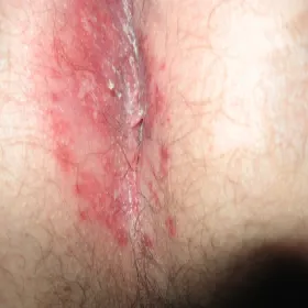 liszaj płaski okołoodbytniczy