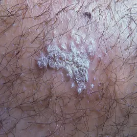 liszaj płaski zanikowy