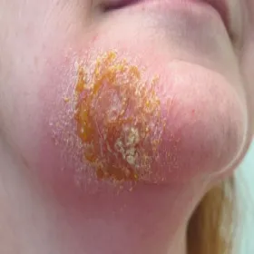 liszajec zakaźny na twarzy