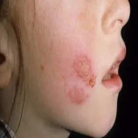 liszajec zakaźny u dzieci na twarzy
