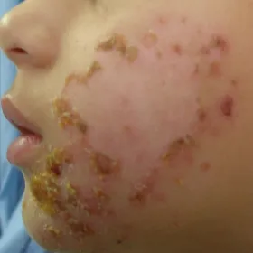 liszajec zakaźny u dziecka