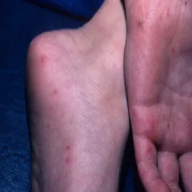 małe czerwone plamki na stopach i dłoniach 