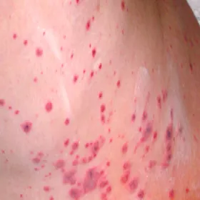 małopłytkowości samoistna