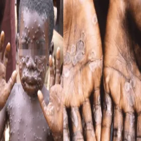 małpia ospa objawy skórne