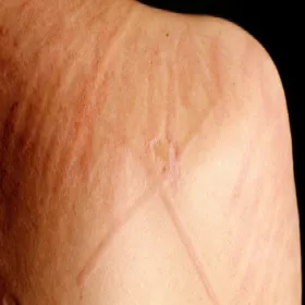 mechaniczne podrażnienie skóry pokrzywka dermograficzna