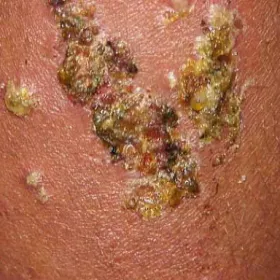  miodowo żółte strupy liszajec