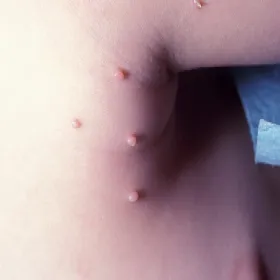 molluscum contagiosum