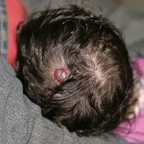 Naczyniak u dziecka na głowie