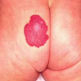 naczyniaki u niemowląt