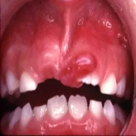 nadziąślak u dzieci 