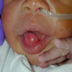 nadziąślak u niemowlaka