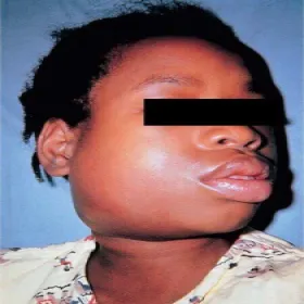 nagminne zapalenie przyusznic u dorosłych