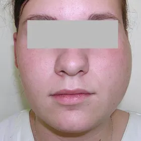 nagminne zapalenie przyusznic