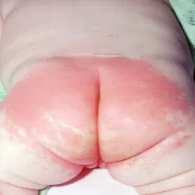 napkin dermatitis