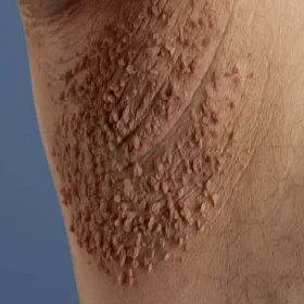 narośl pod pachą włókniaki miękkie 