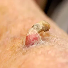 narośl wystająca ponad powierzchnię skóry