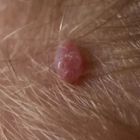 narośla na skórze zdjęcia