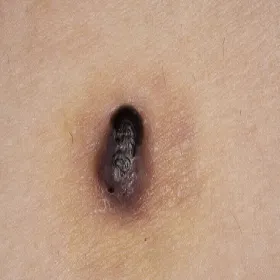 nodular melanoma