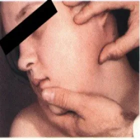 objawy świnki u dzieci