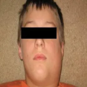 obrzęk gruczołów ślinowych świnka