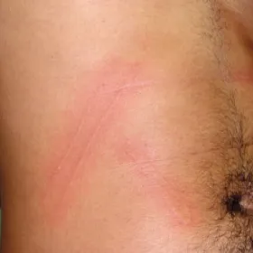 odgniecenia na skórze