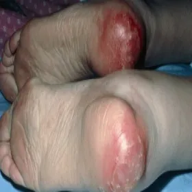 odleżyny na piętach