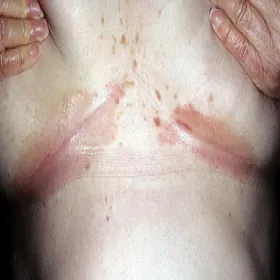 odparzenia pod biustem zdjęcia