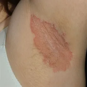 odparzenia pod pachami