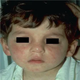 odra choroba u dzieci