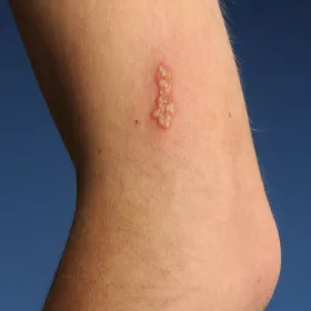 opryszczka na ramieniu