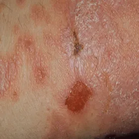 ostry uogólniony liszaj płaski