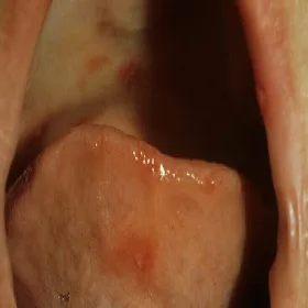 owrzodzenie jamy ustnej