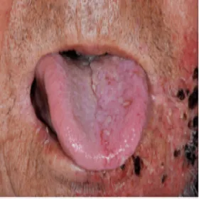 półpasiec na języku