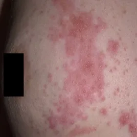 półpasiec na piersiach