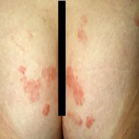 półpasiec na pośladkach