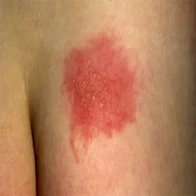 półpasiec na pośladku