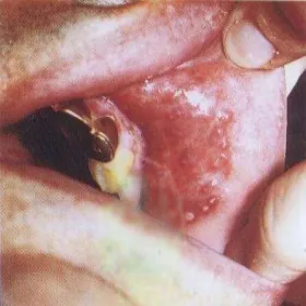 półpasiec w jamie ustnej