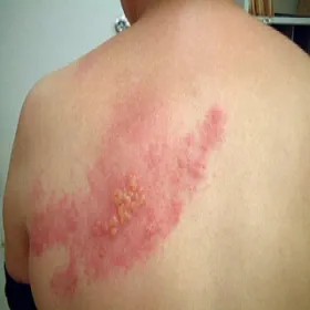 półpasiec zdjęcia