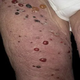 pęcherze wypełnione płynem na nogach