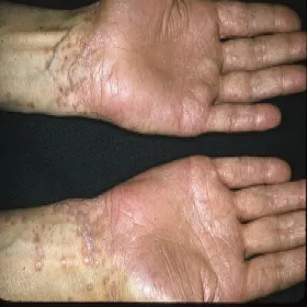 pęcherzowy liszaj płaski