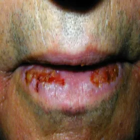 pęcherzyca zwykła na ustach