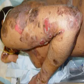 pęcherzyca zwykła skórna