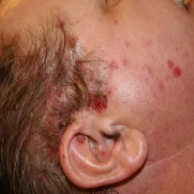 pęcherzyca zwykła u dziecka