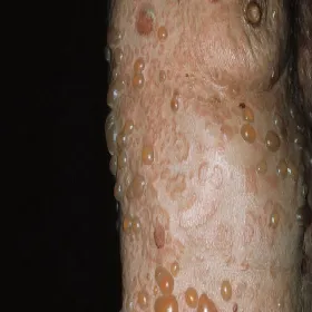 pęcherzyki z płynem surowiczym na ciele