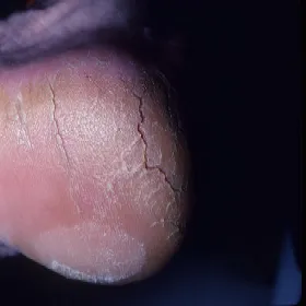 pękająca skóra na piętach