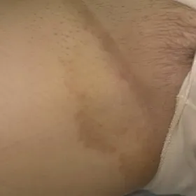 pachwina udowa swędzenie erythrasma 