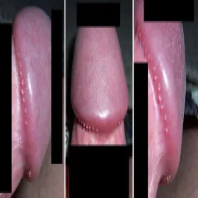 papillomatosis coronae penis