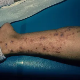 pemfigoidopodobny liszaj płaski