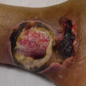 piodermia zgorzelinowa 