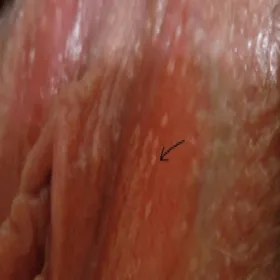 plamki fordyce'a na sromie